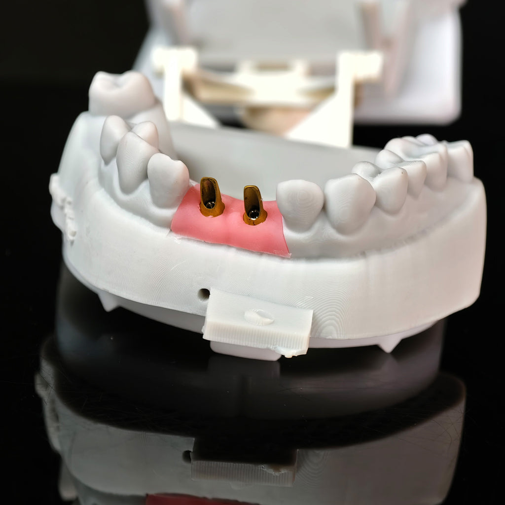 Zirconia Crowns With Gold-Plated Abutment And Implant Seating Guide