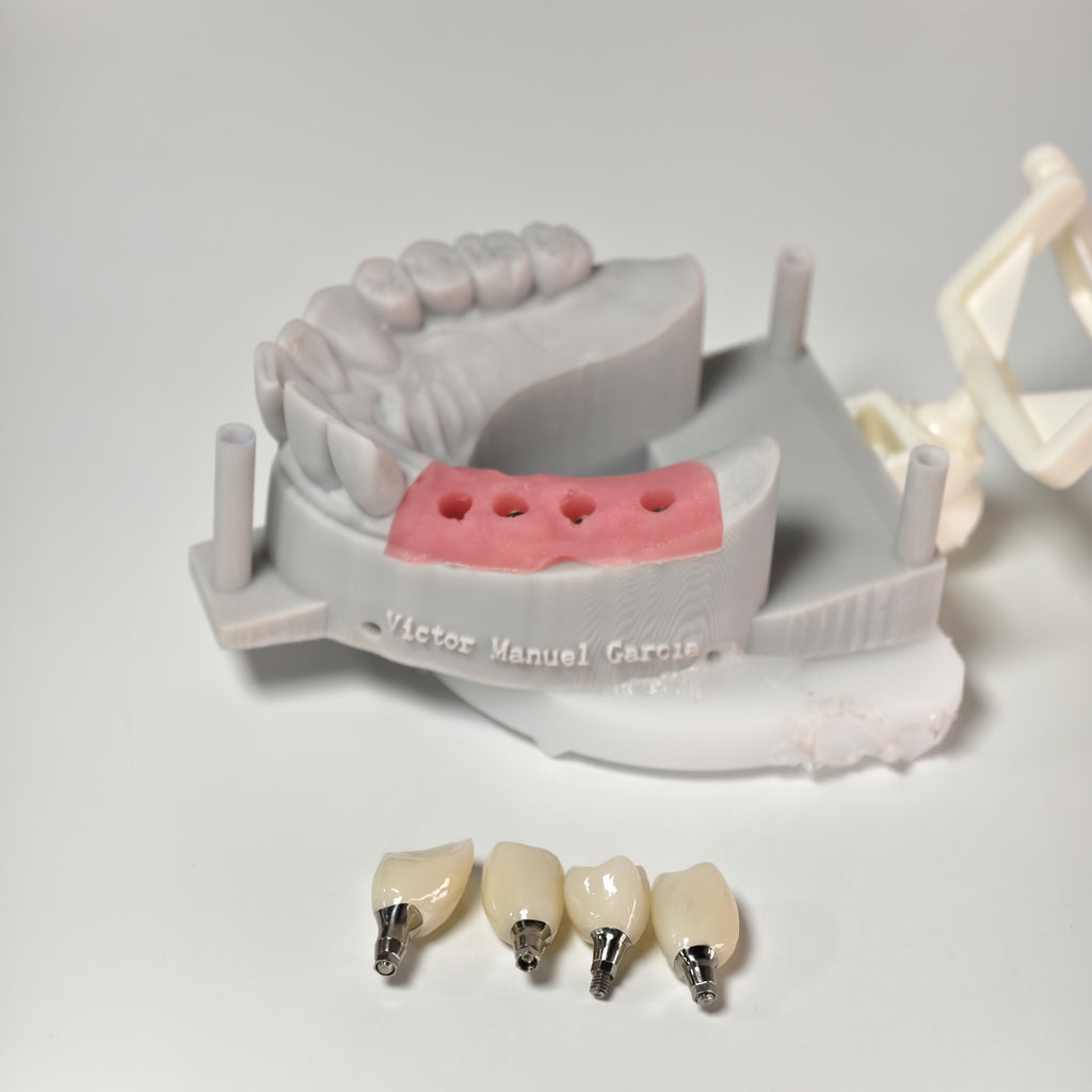 Zirconia Crowns With Screw Retained