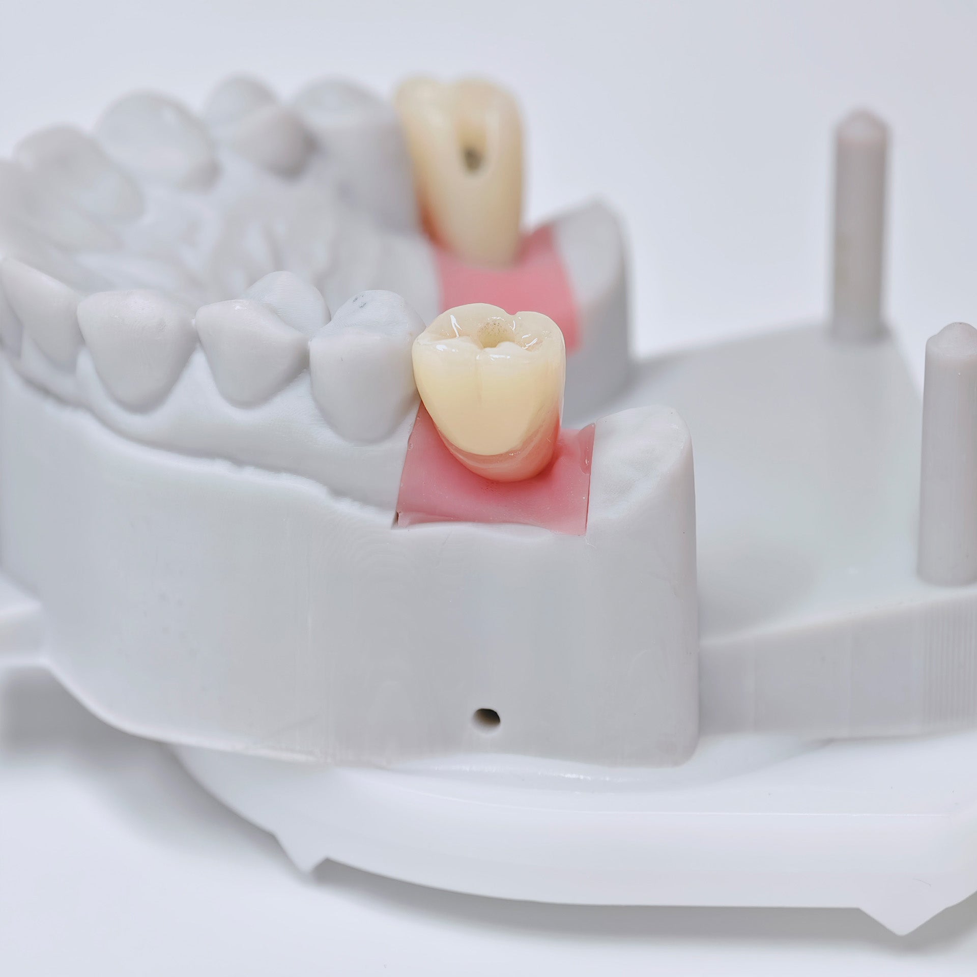 Zirconia Crowns With Screw Retained