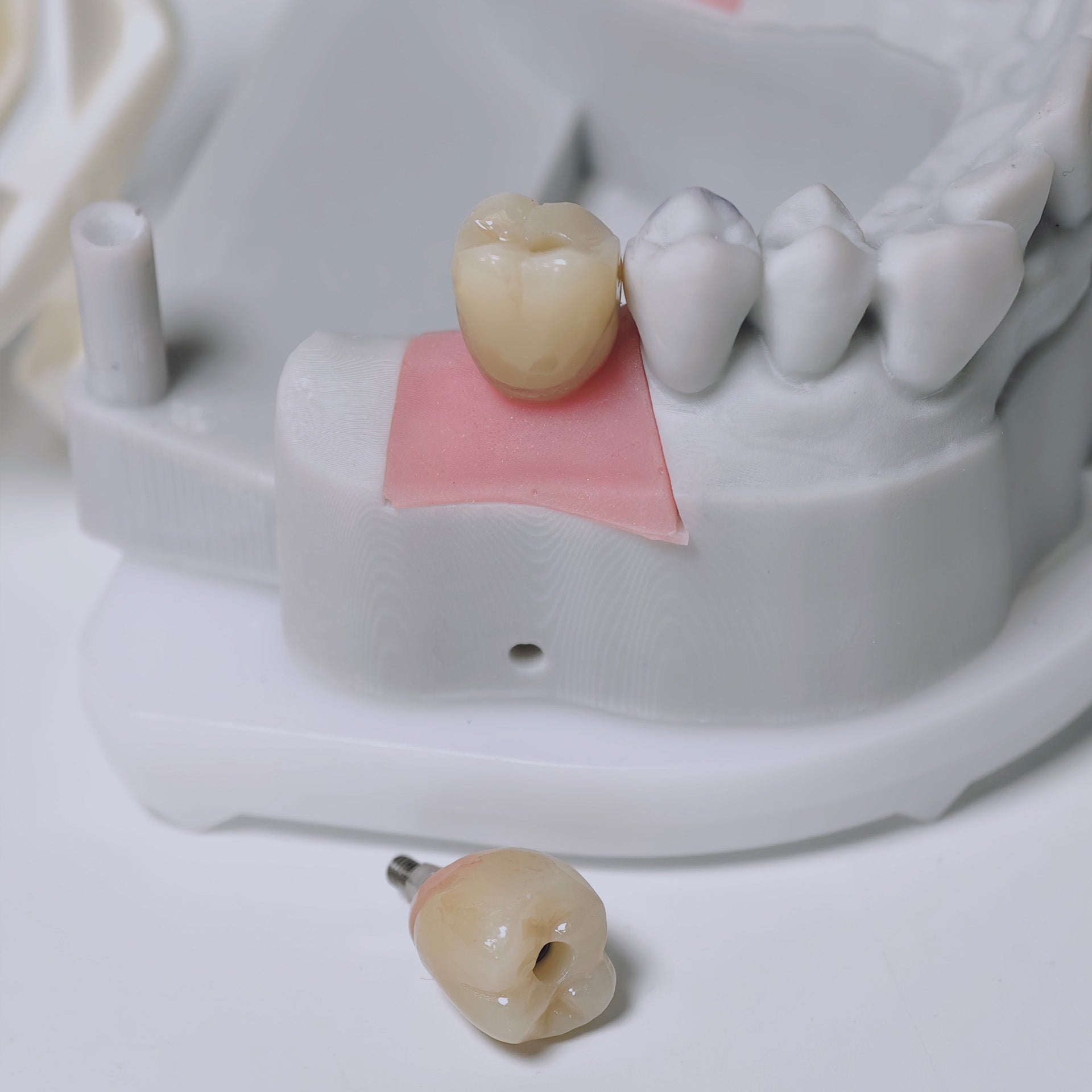 Zirconia Crowns With Screw Retained