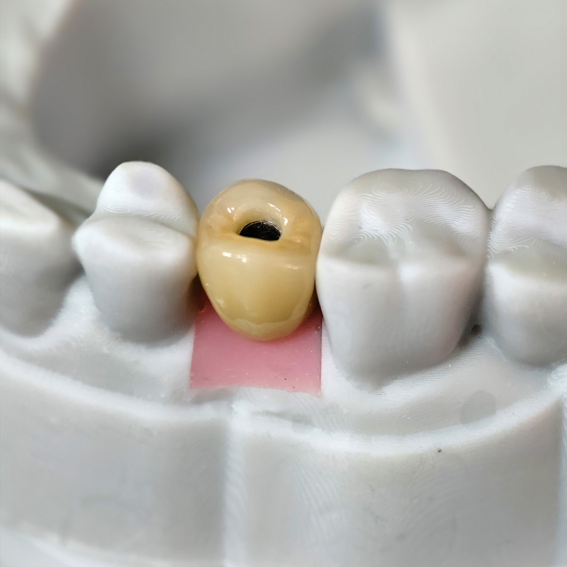 Zirconia Crowns With Screw Retained