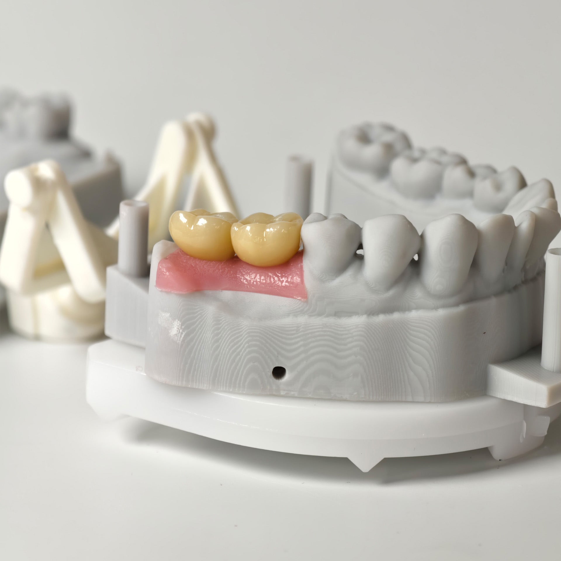 Zirconia Crowns With Screw Retained