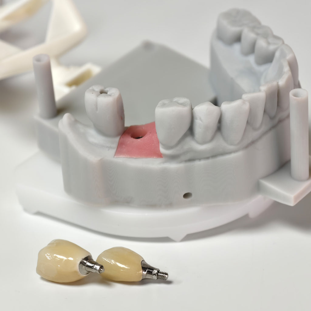Zirconia Crowns With Screw Retained