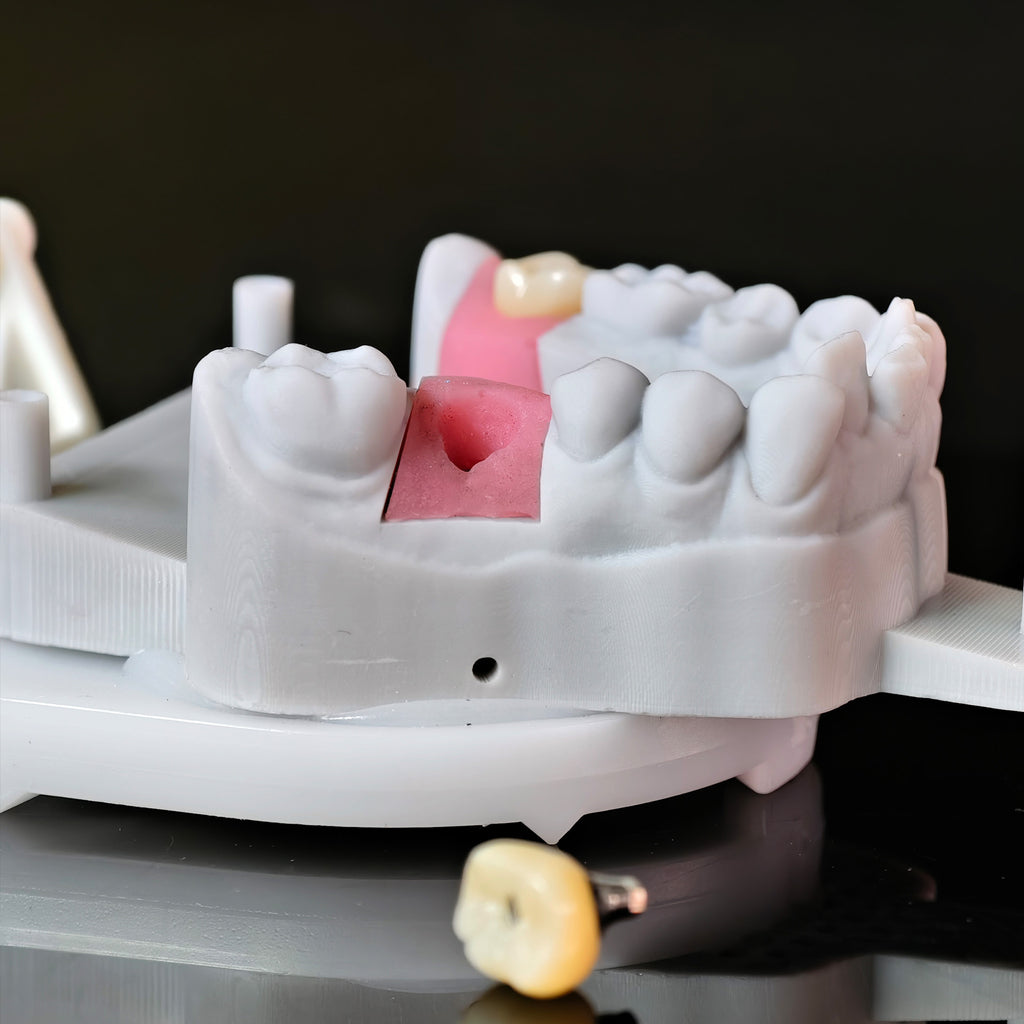Zirconia Crowns With Screw Retained