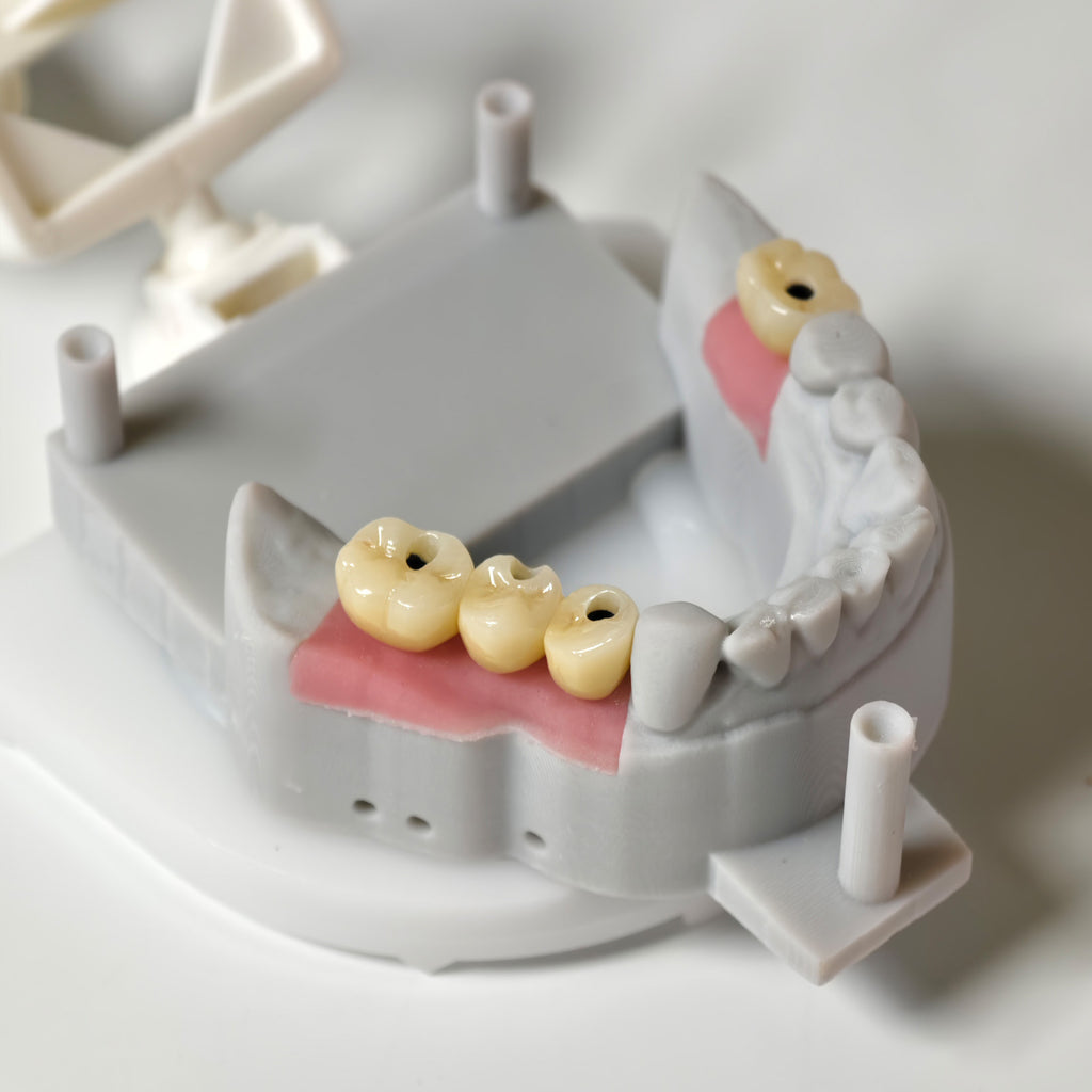 Zirconia Crowns With Screw Retained