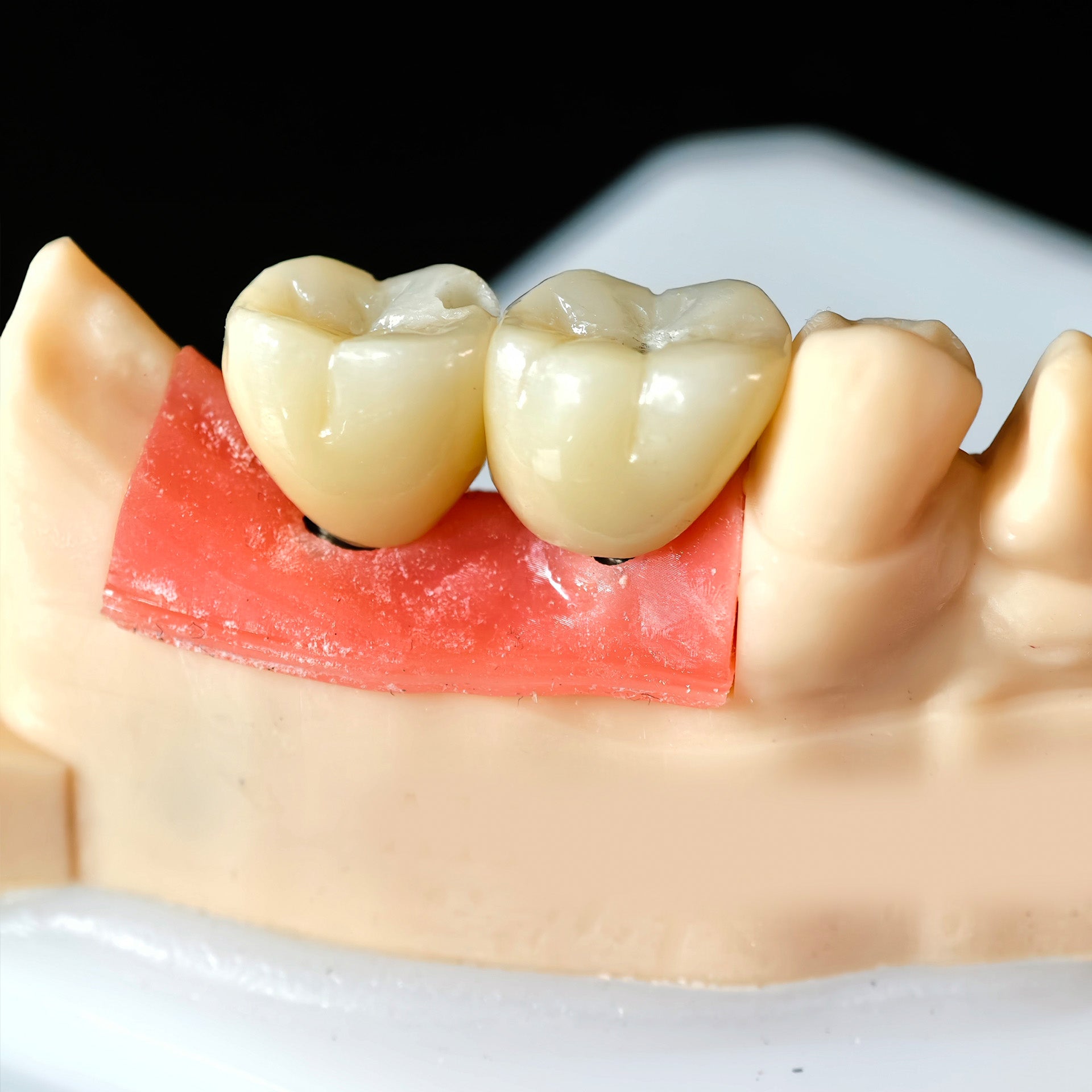 Zirconia Crowns With Screw Retained