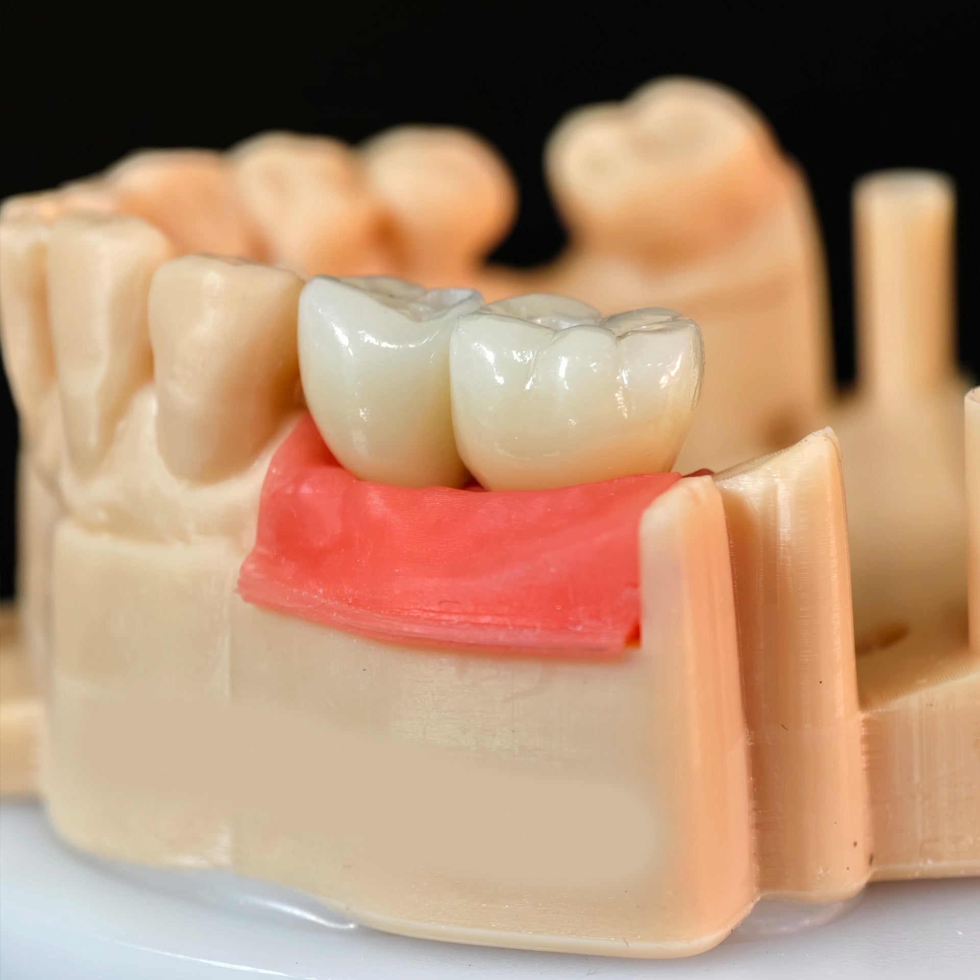 Zirconia Crowns With Screw Retained