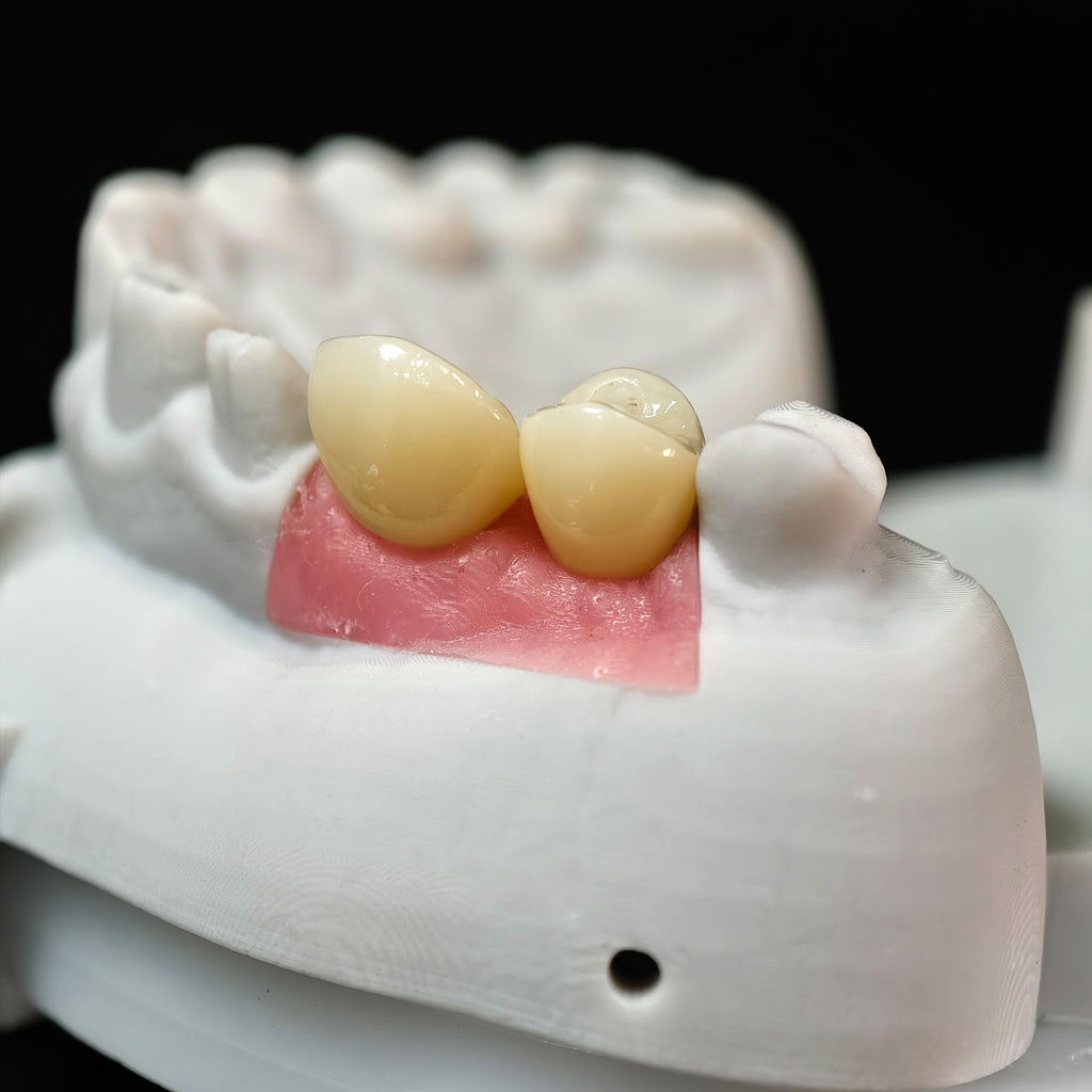 Zirconia Crowns With Screw Retained