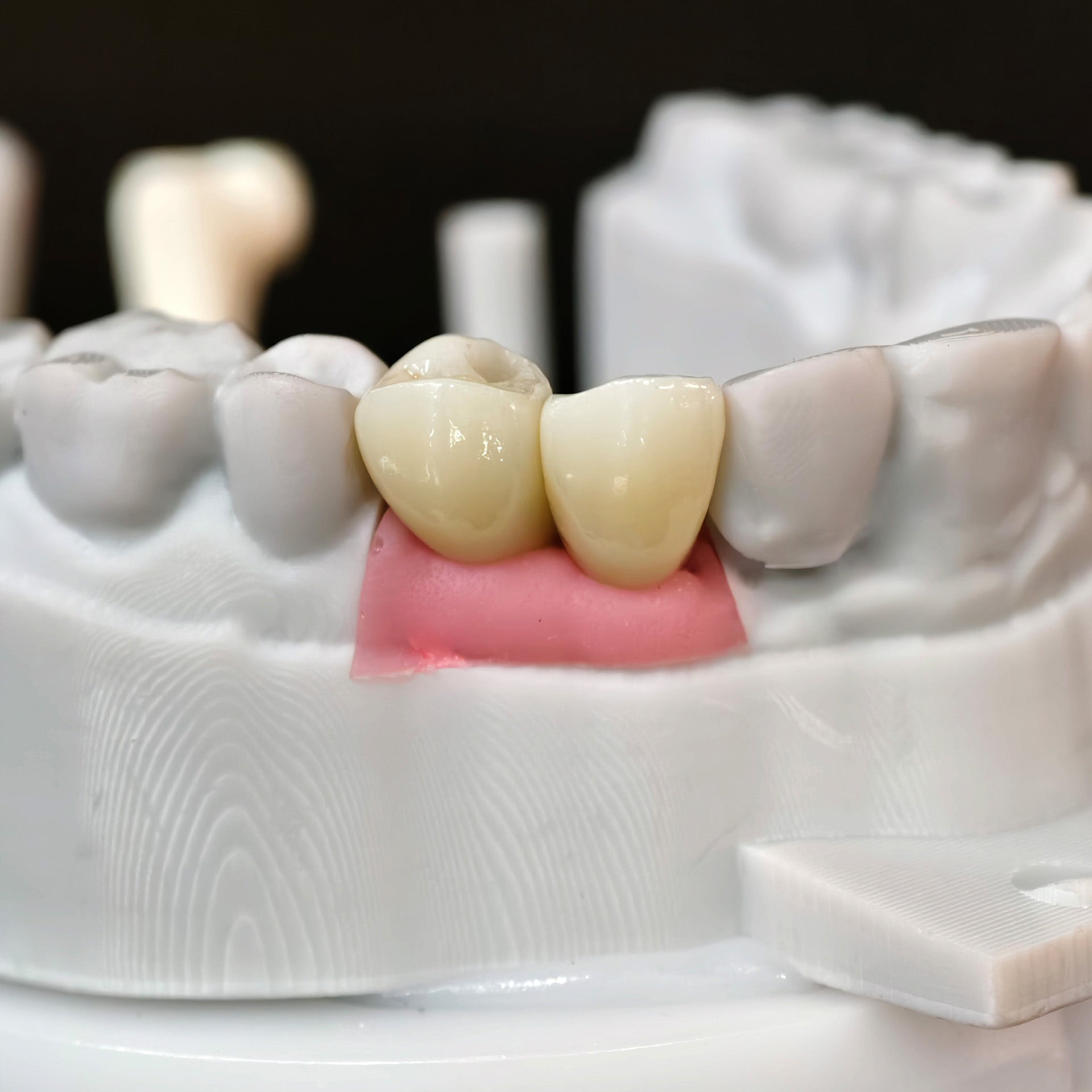 Zirconia Crowns With Screw Retained