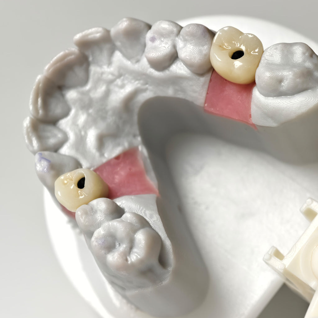 Zirconia Crowns With Screw Retained