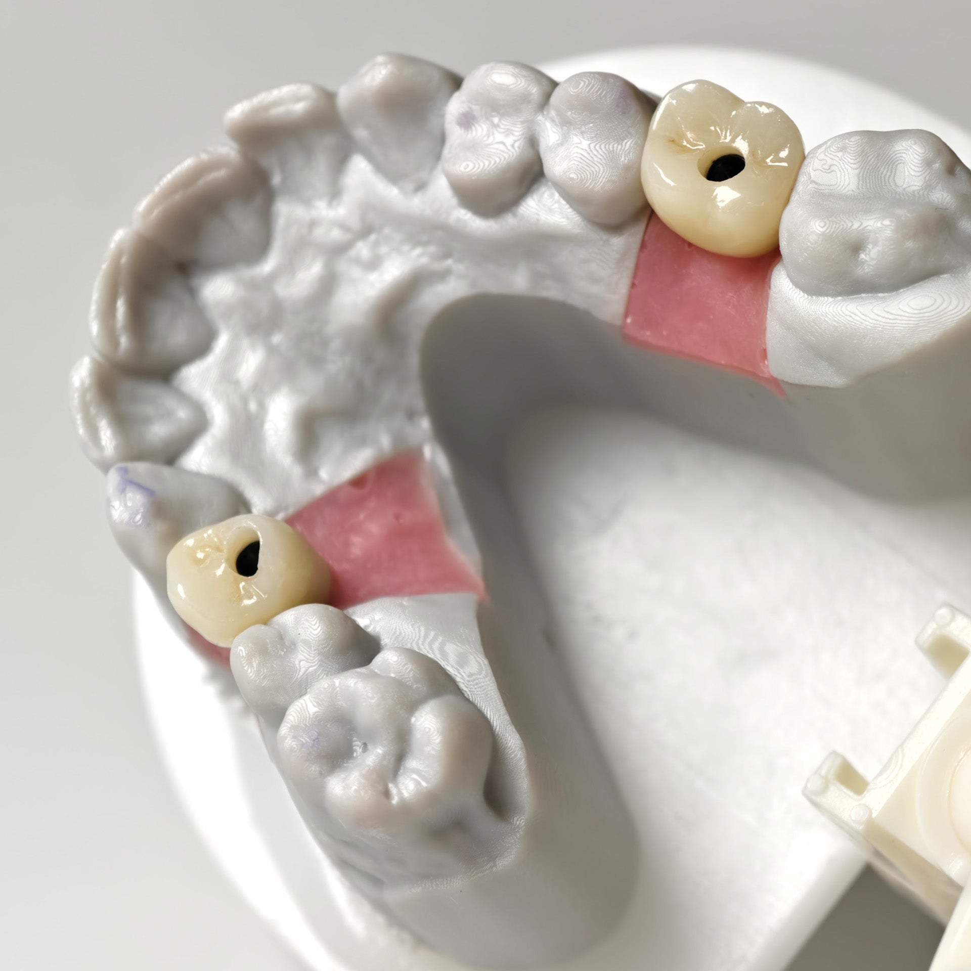 Zirconia Crowns With Screw Retained