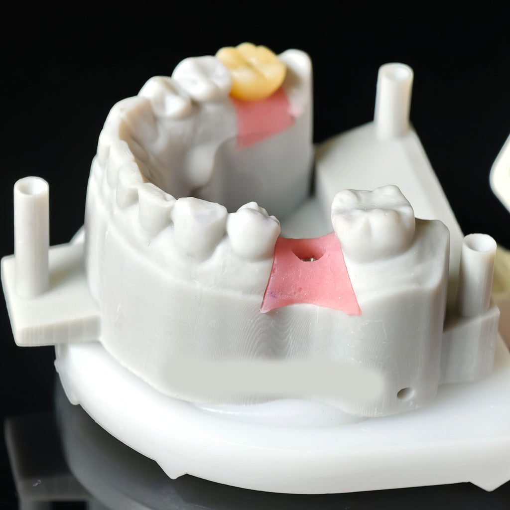 Zirconia Crowns With Screw Retained
