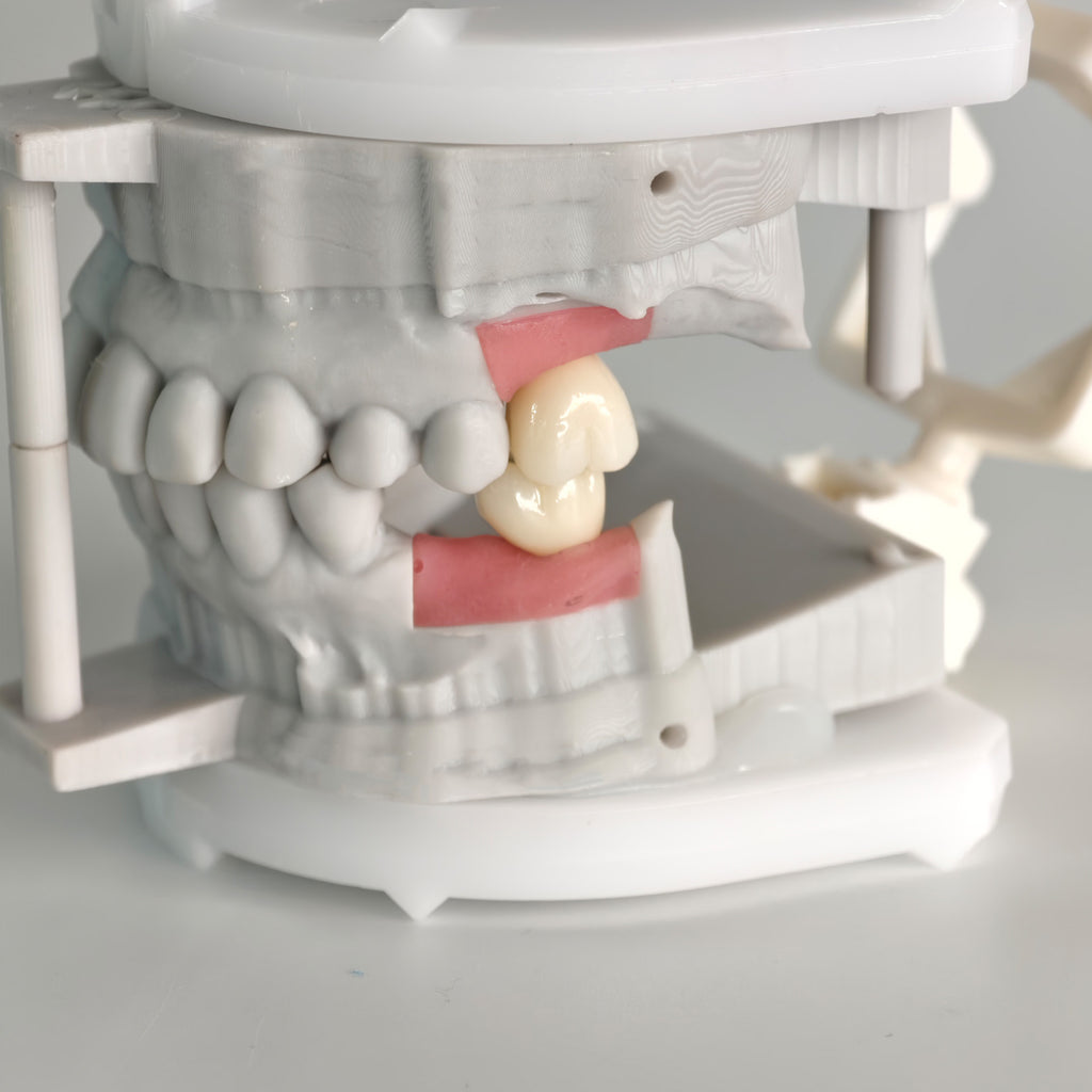 Zirconia Crowns With Screw Retained
