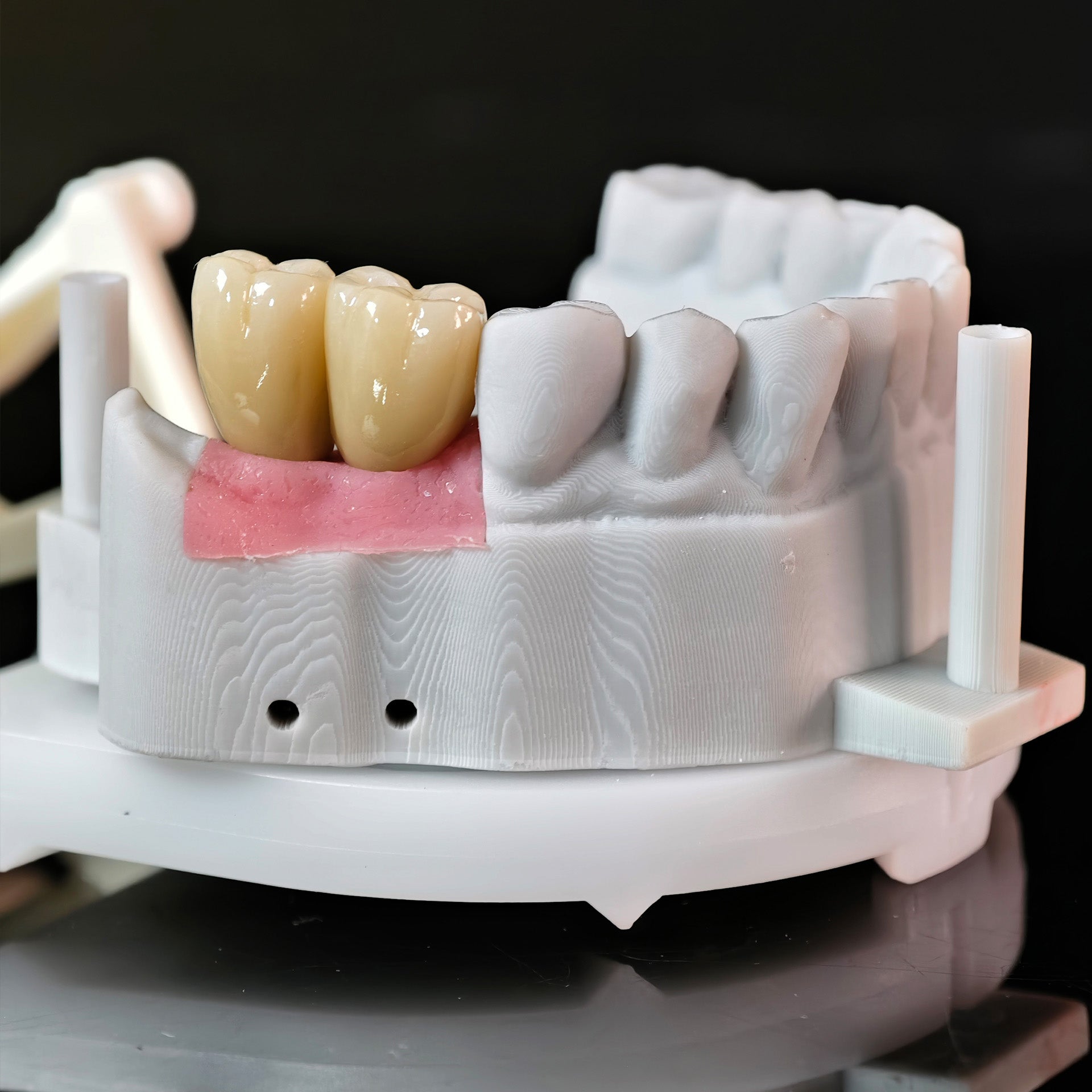 Zirconia Crowns With Screw Retained