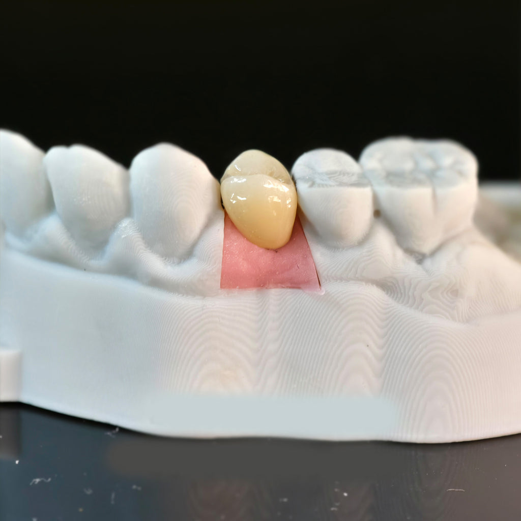 Zirconia Crowns With Screw Retained