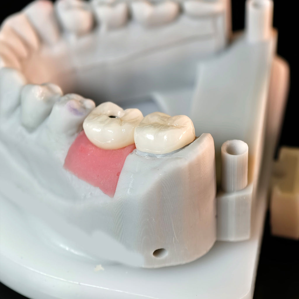 Zirconia Crowns With Screw Retained And Cement Retained