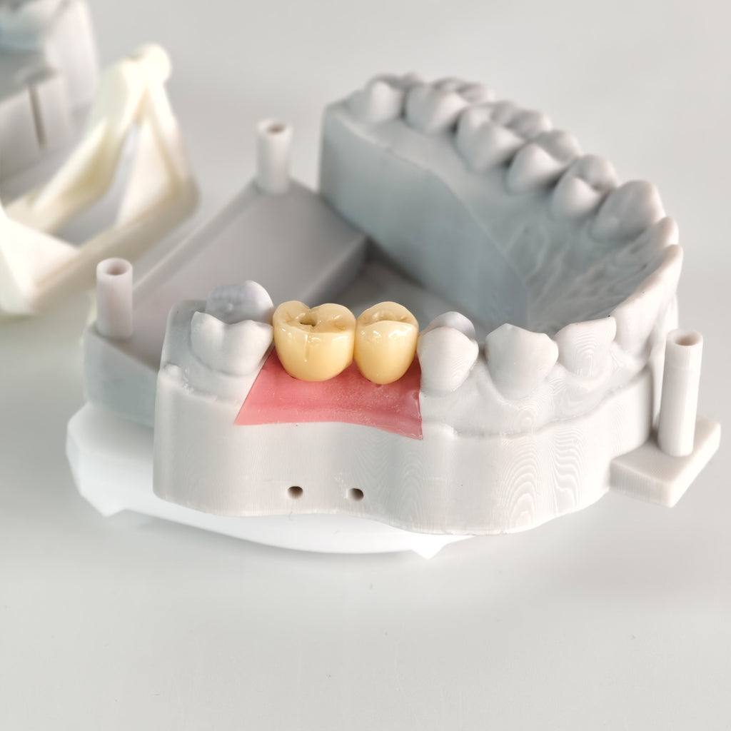 Zirconia Crowns With Screw Retained And Gold-Plated Custom Abutment