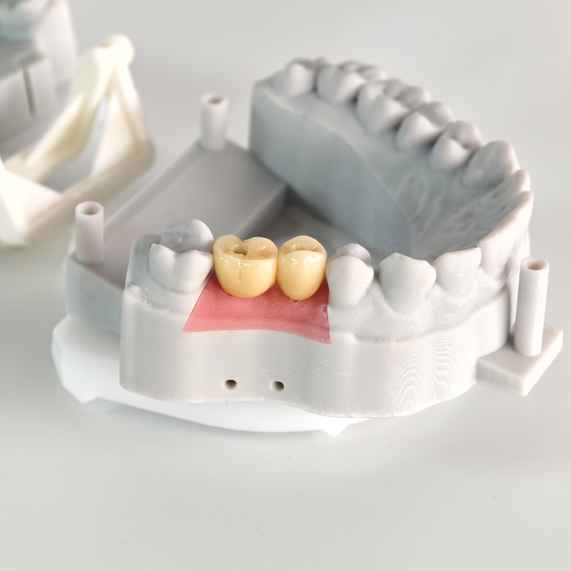 Zirconia Crowns With Screw Retained And Gold-Plated Custom Abutment