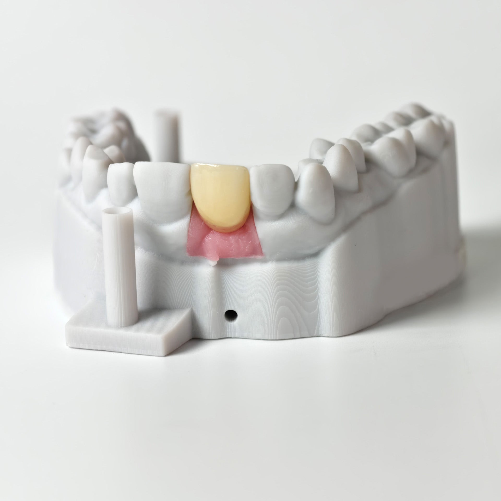 Zirconia Crown With Gold-Plated Abutment