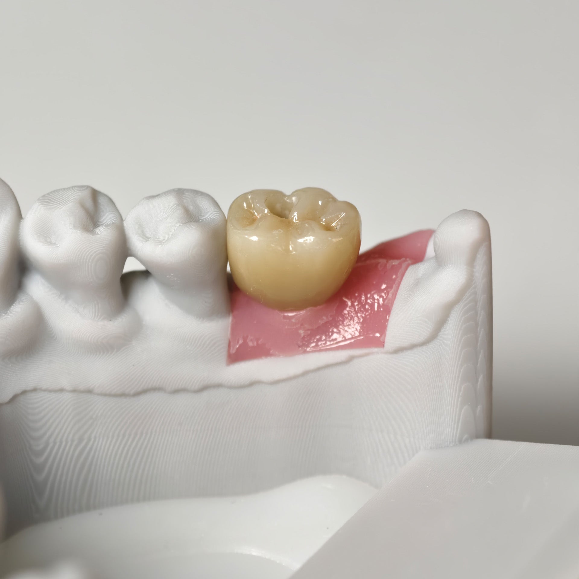 Zirconia Crown With Gold-Plated Abutment