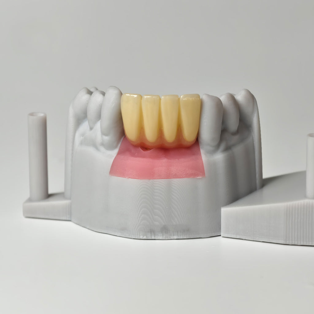 Zirconia Crown With Gold-Plated Abutment