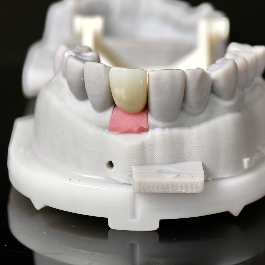 Zirconia Crown With Screw Retained