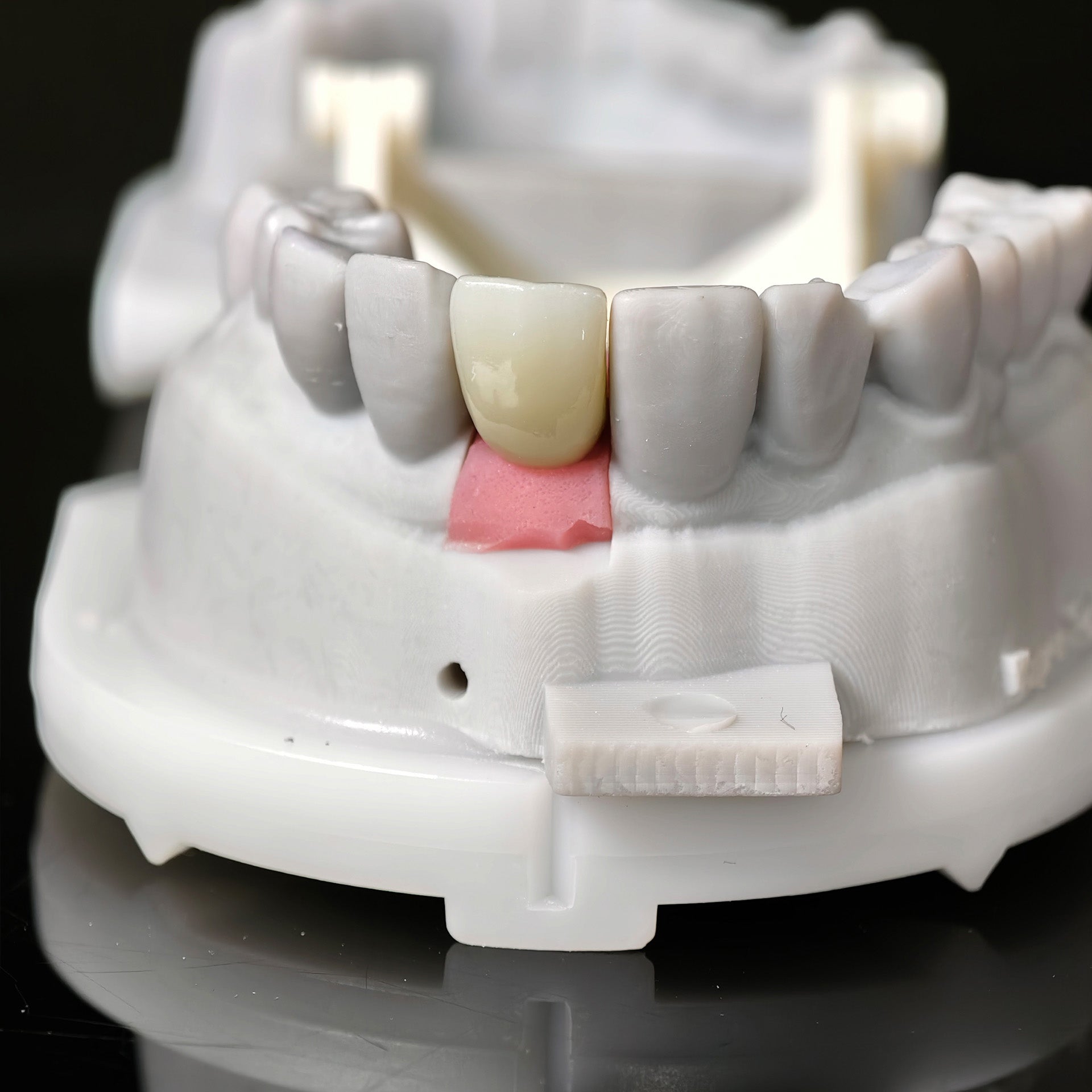 Zirconia Crown With Screw Retained
