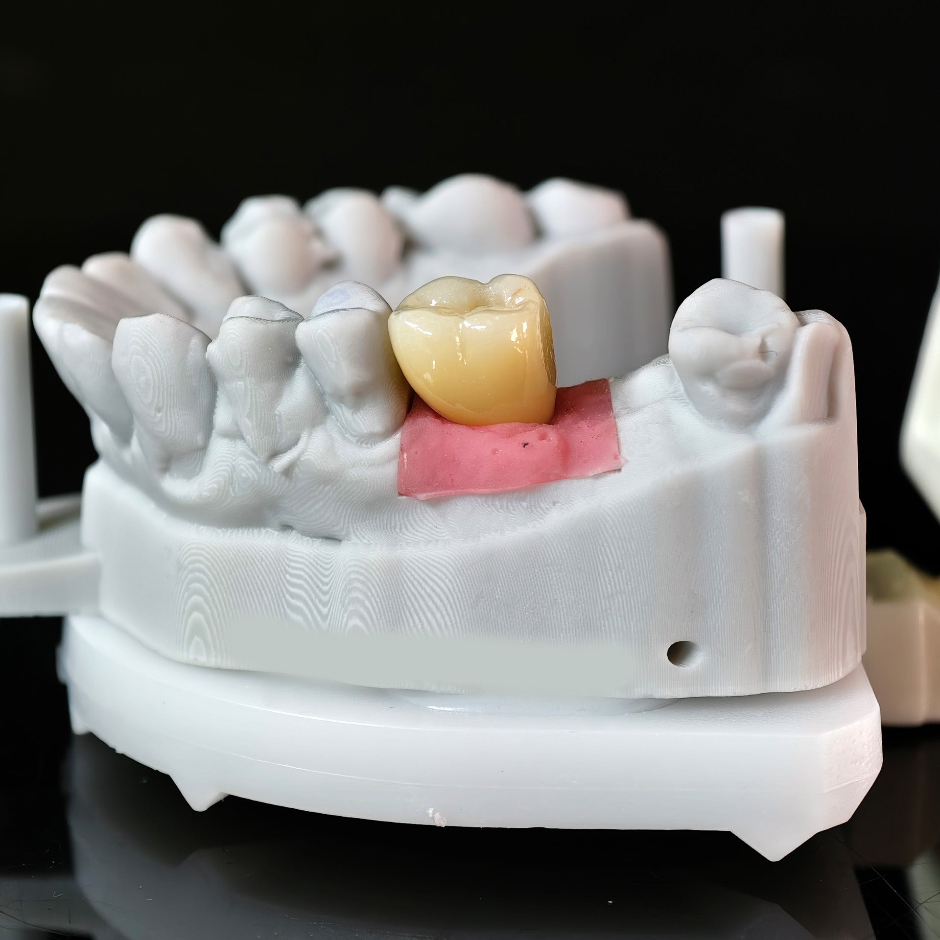 Zirconia Crown With Screw Retained