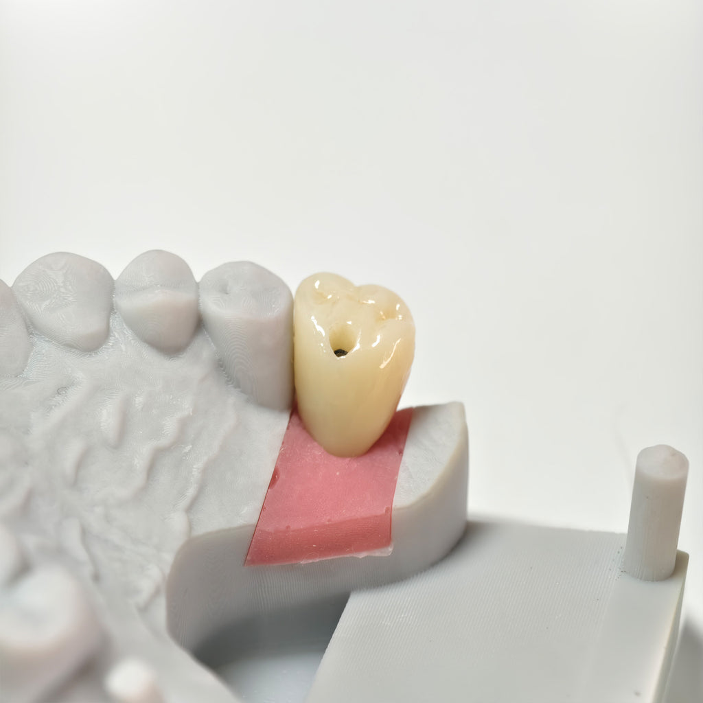 Zirconia Crown With Screw Retained