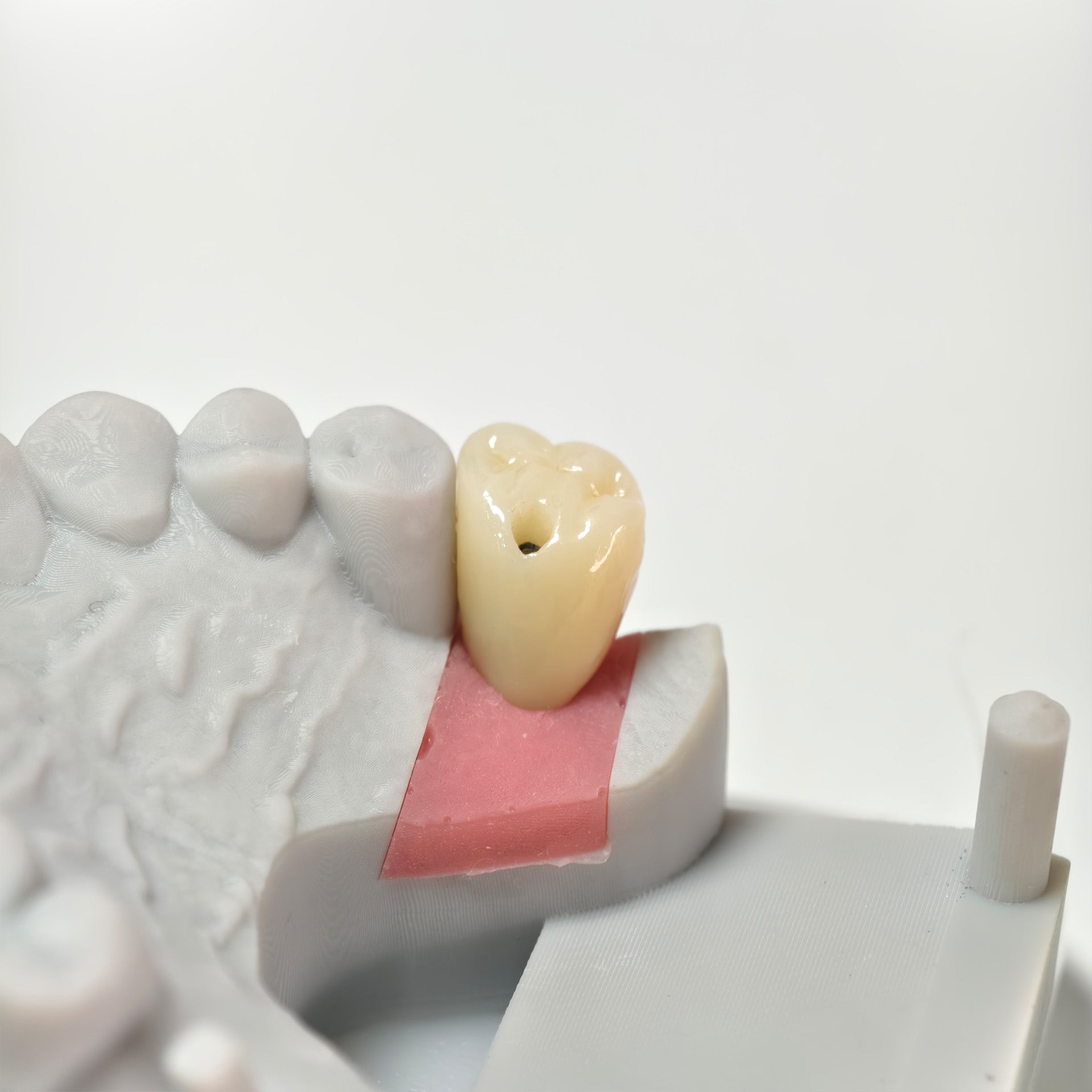 Zirconia Crown With Screw Retained