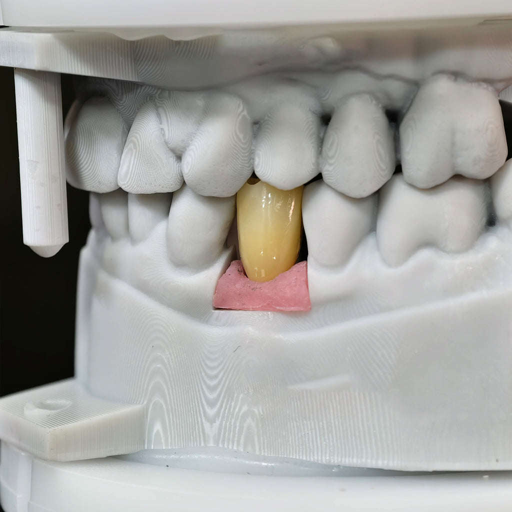 Zirconia Crown With Screw Retained