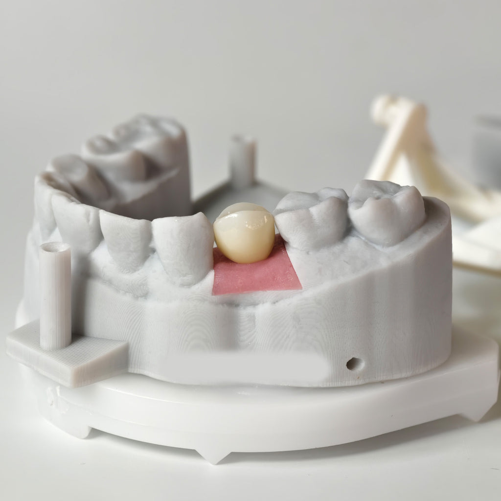 Zirconia Crown With Screw Retained