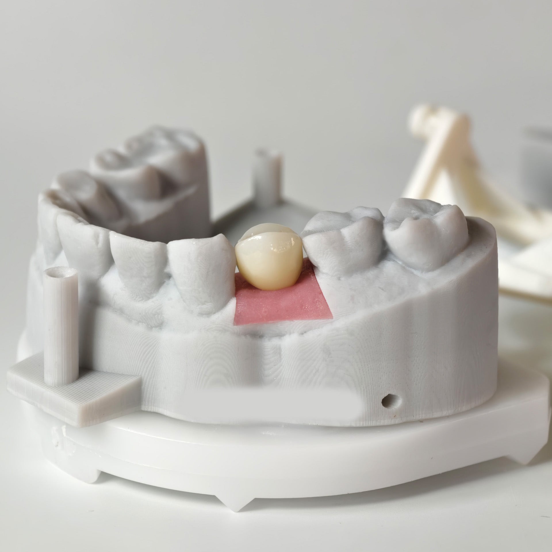 Zirconia Crown With Screw Retained