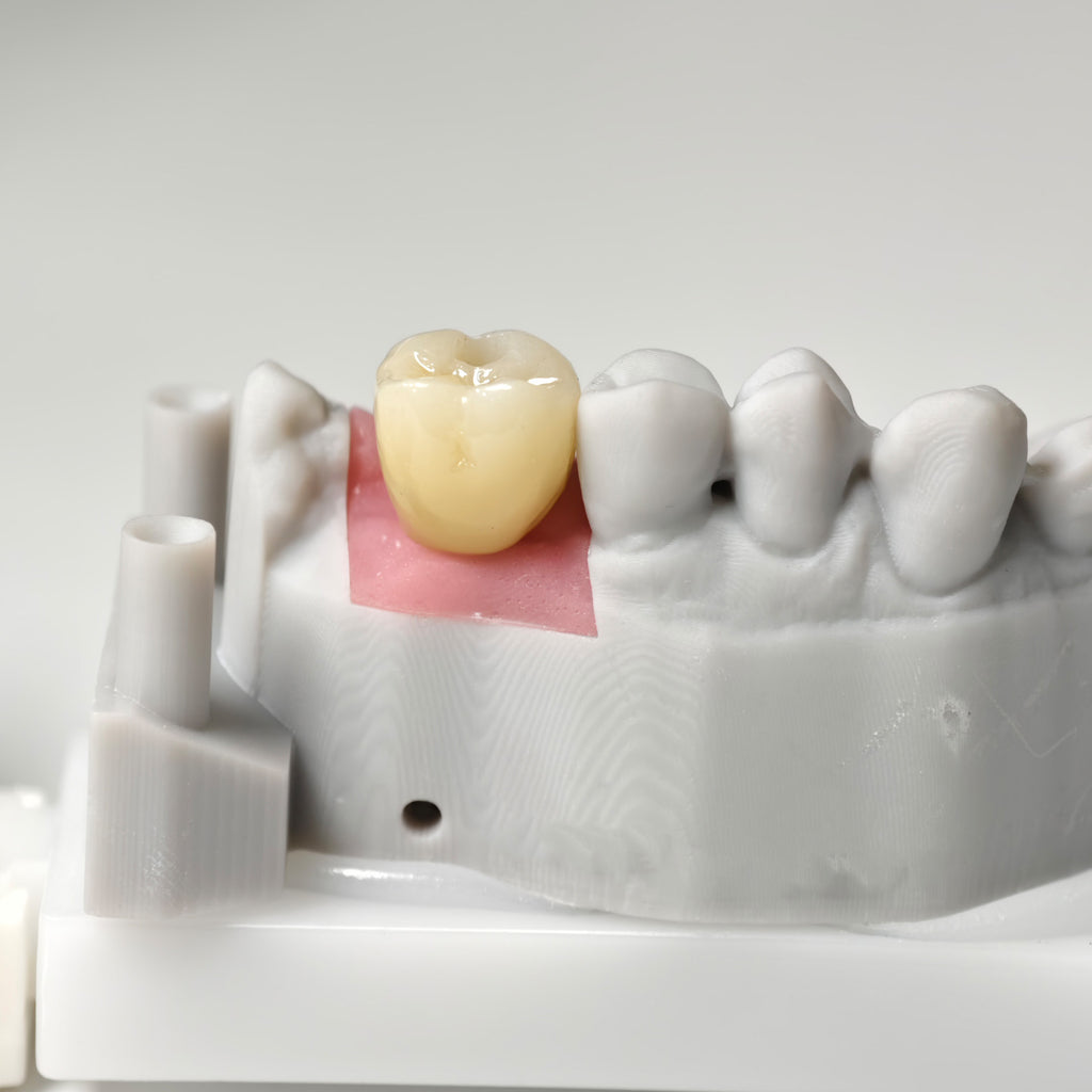 Zirconia Crown With Screw Retained