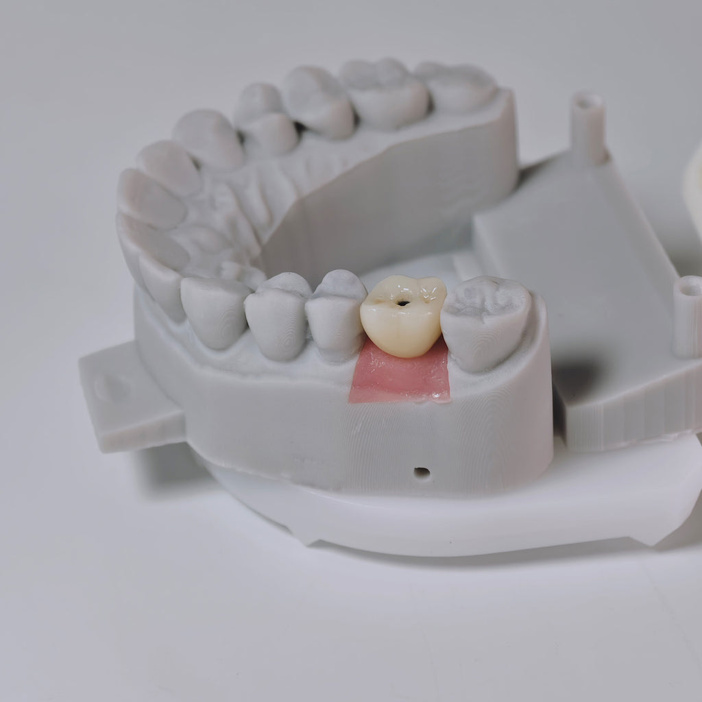 Zirconia Crown With Screw Retained