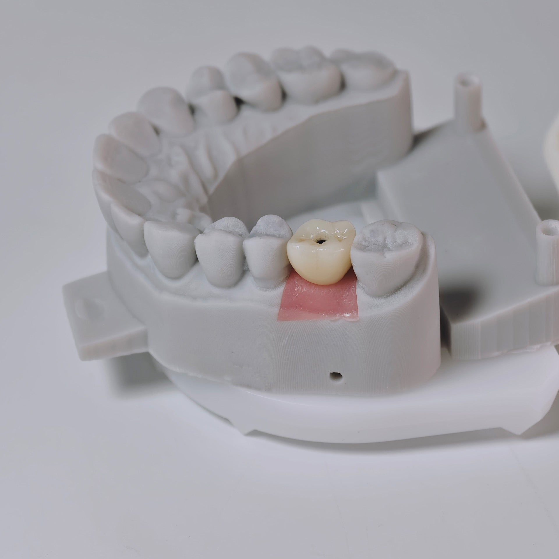 Zirconia Crown With Screw Retained