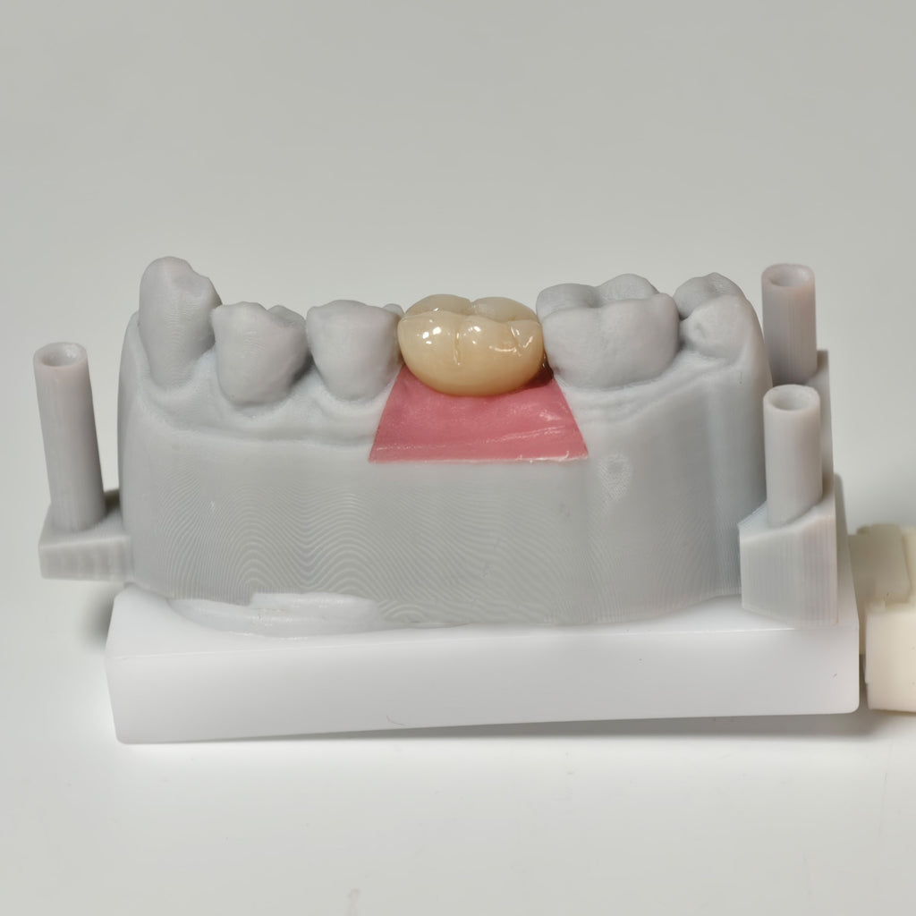 Zirconia Crown With Screw Retained