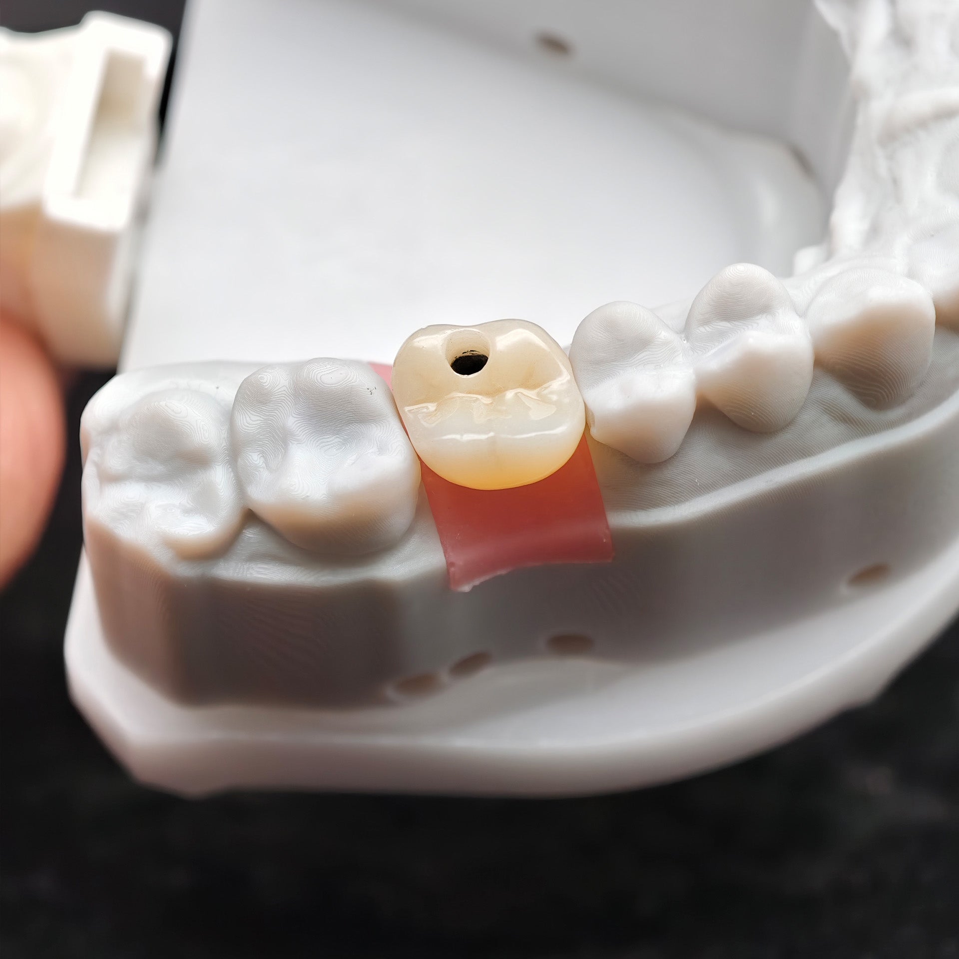 Zirconia Crown With Screw Retained