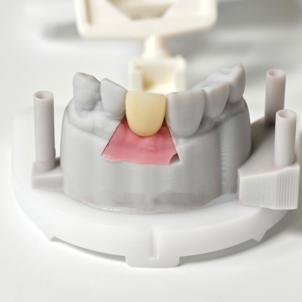 Zirconia Crown With Screw Retained
