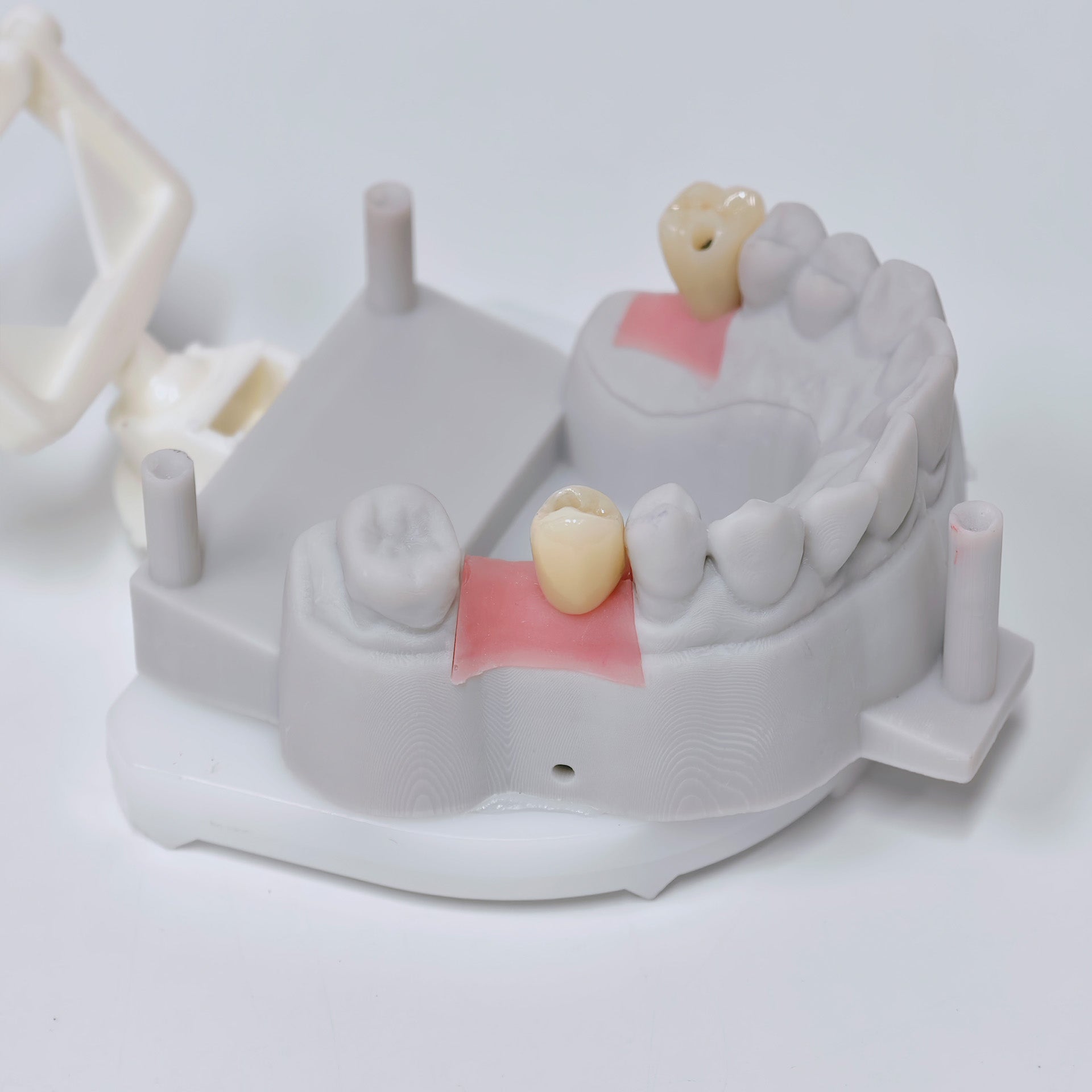 Zirconia Crown With Screw Retained
