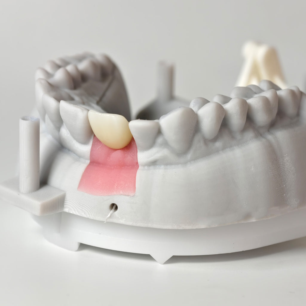 Zirconia Crown With Screw Retained