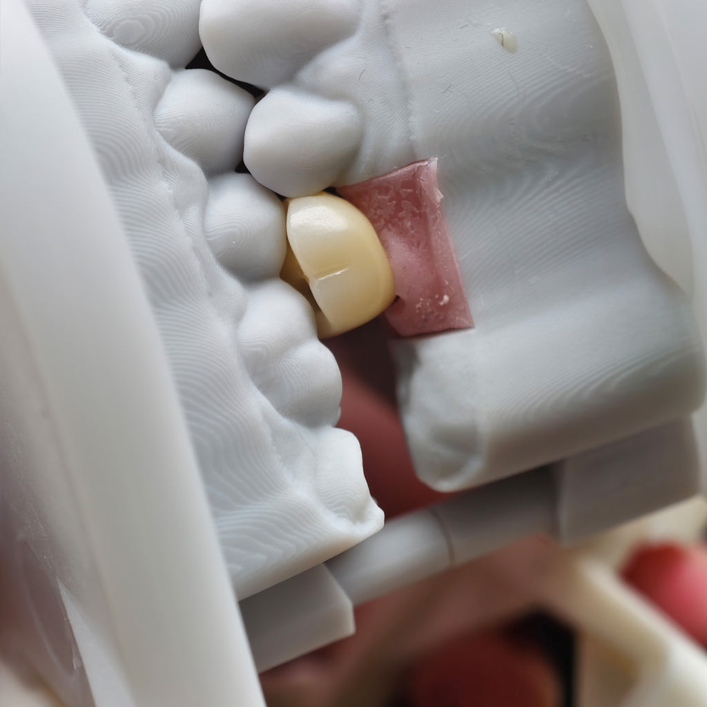 Zirconia Crown With Screw Retained