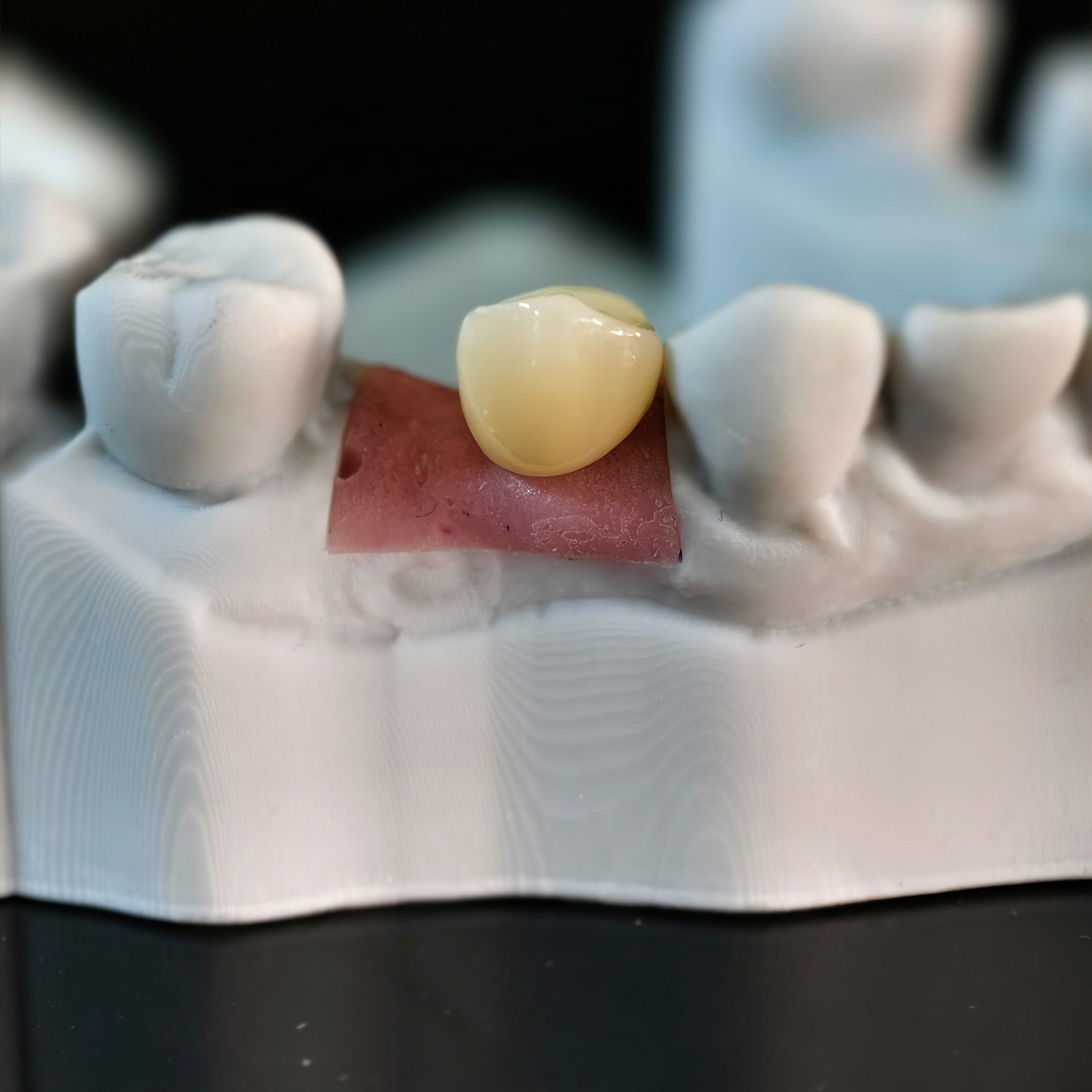 Zirconia Crown With Screw Retained