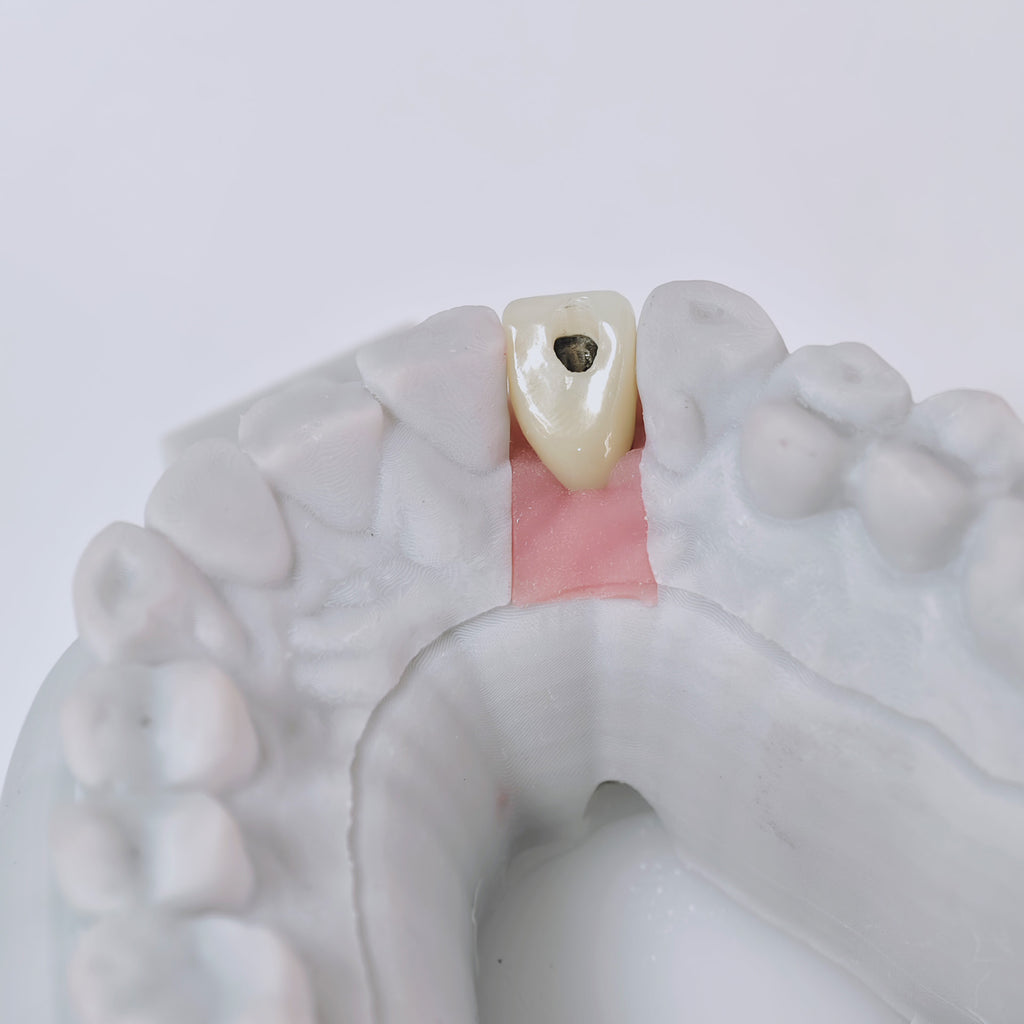 Zirconia Crown With Screw Retained
