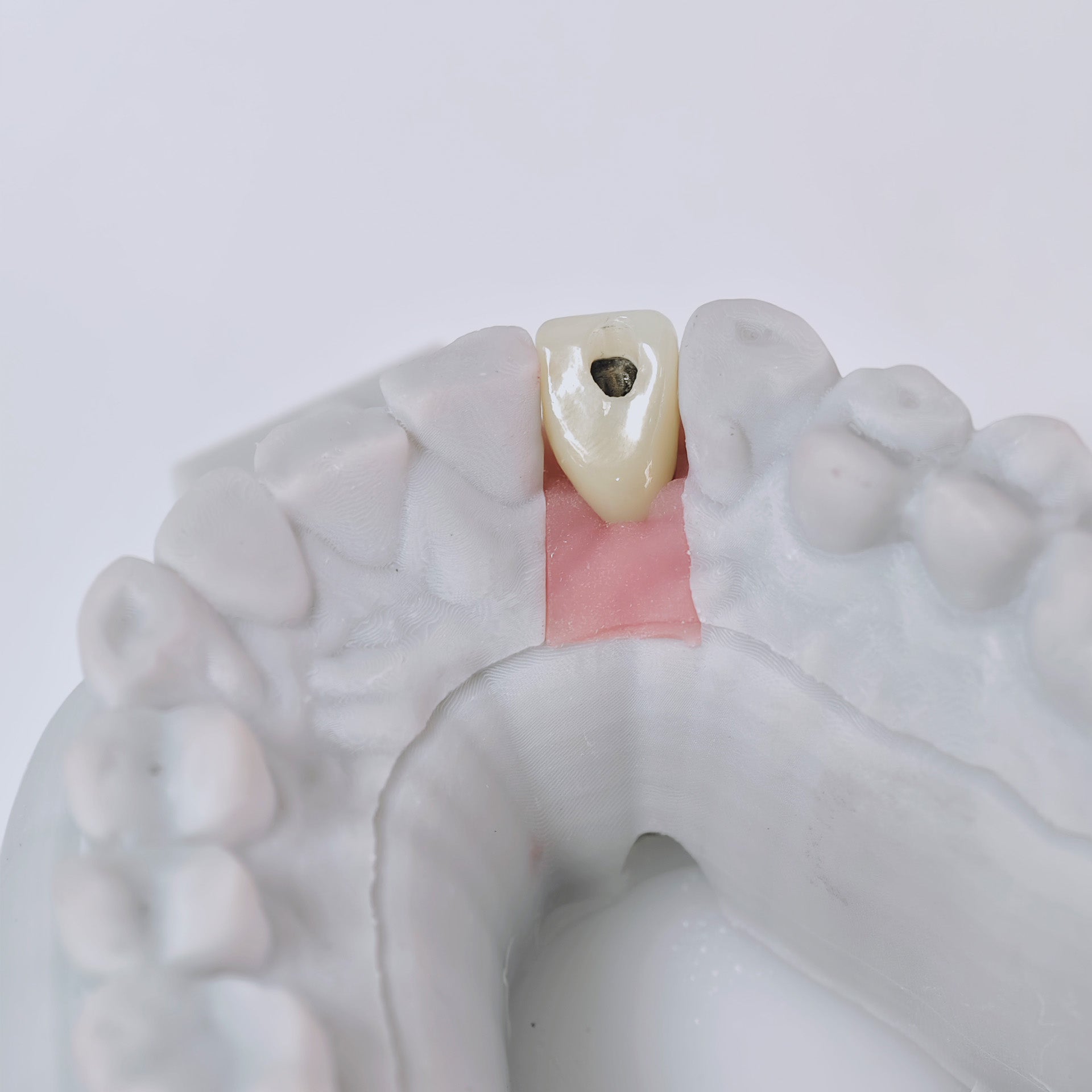 Zirconia Crown With Screw Retained