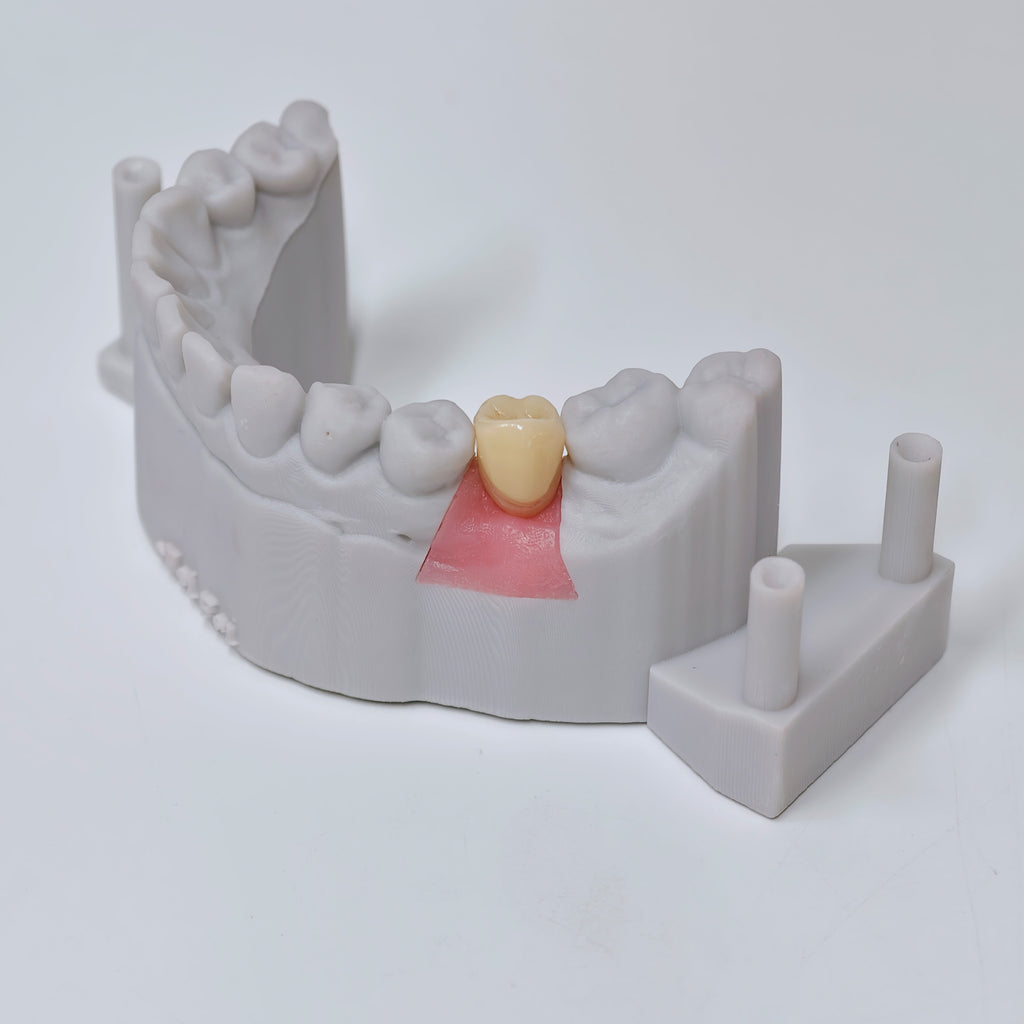 Zirconia Crown With Screw Retained