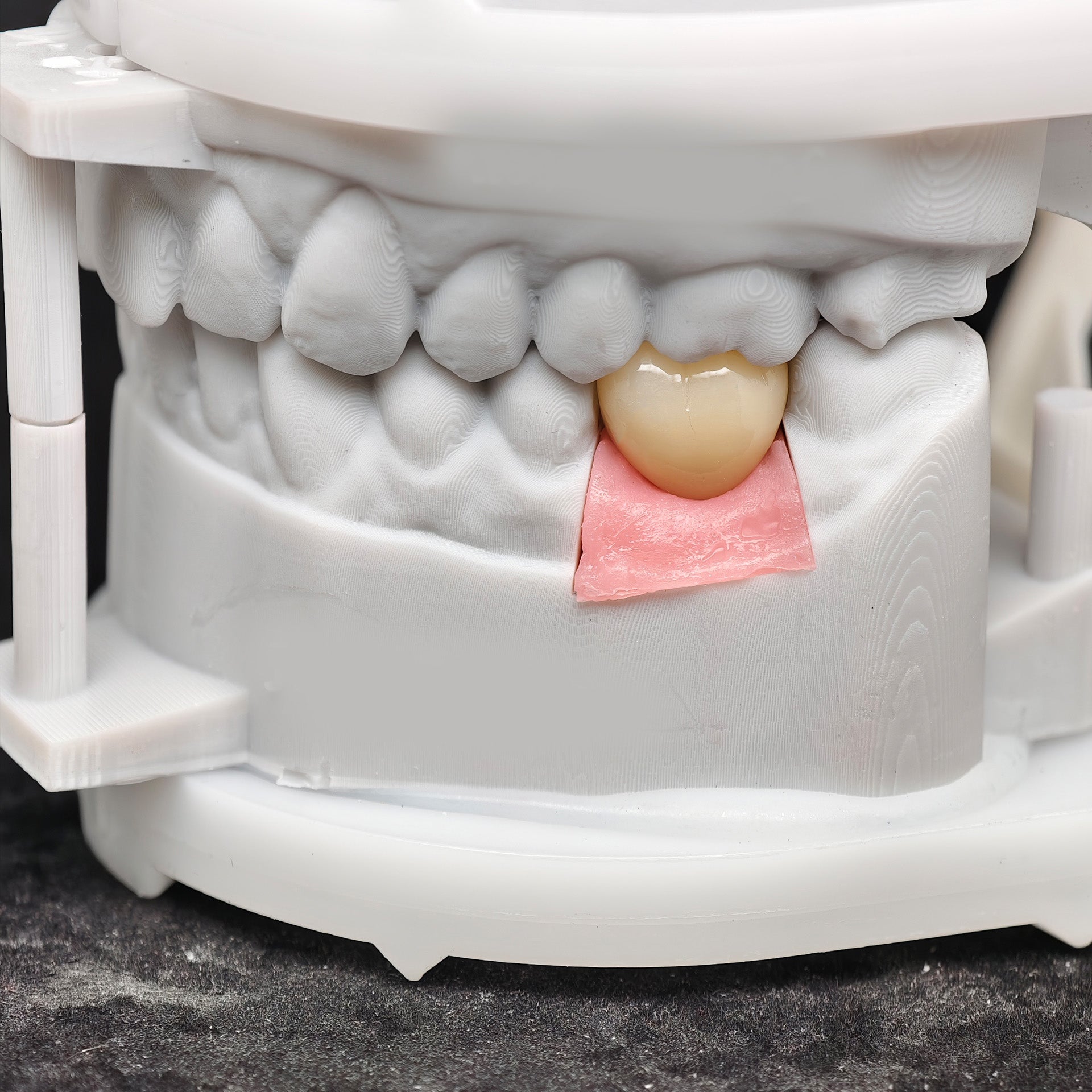 Zirconia Crown With Screw Retained