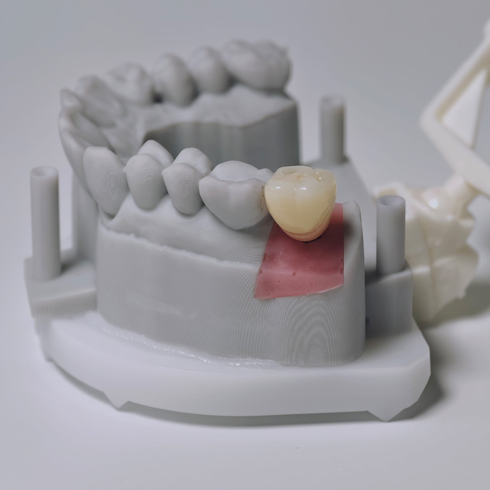 Zirconia Crown With Screw Retained