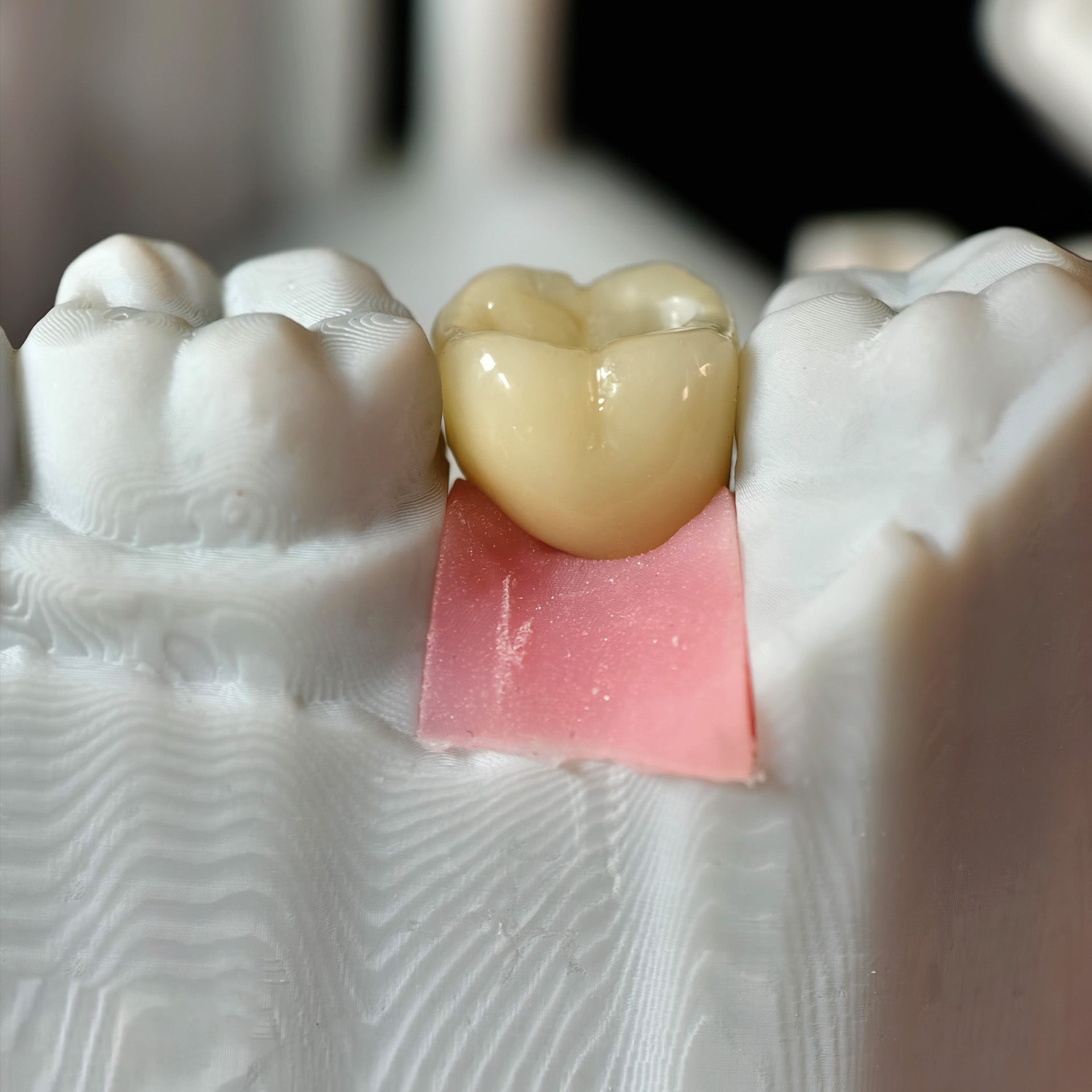 Zirconia Crown With Screw Retained