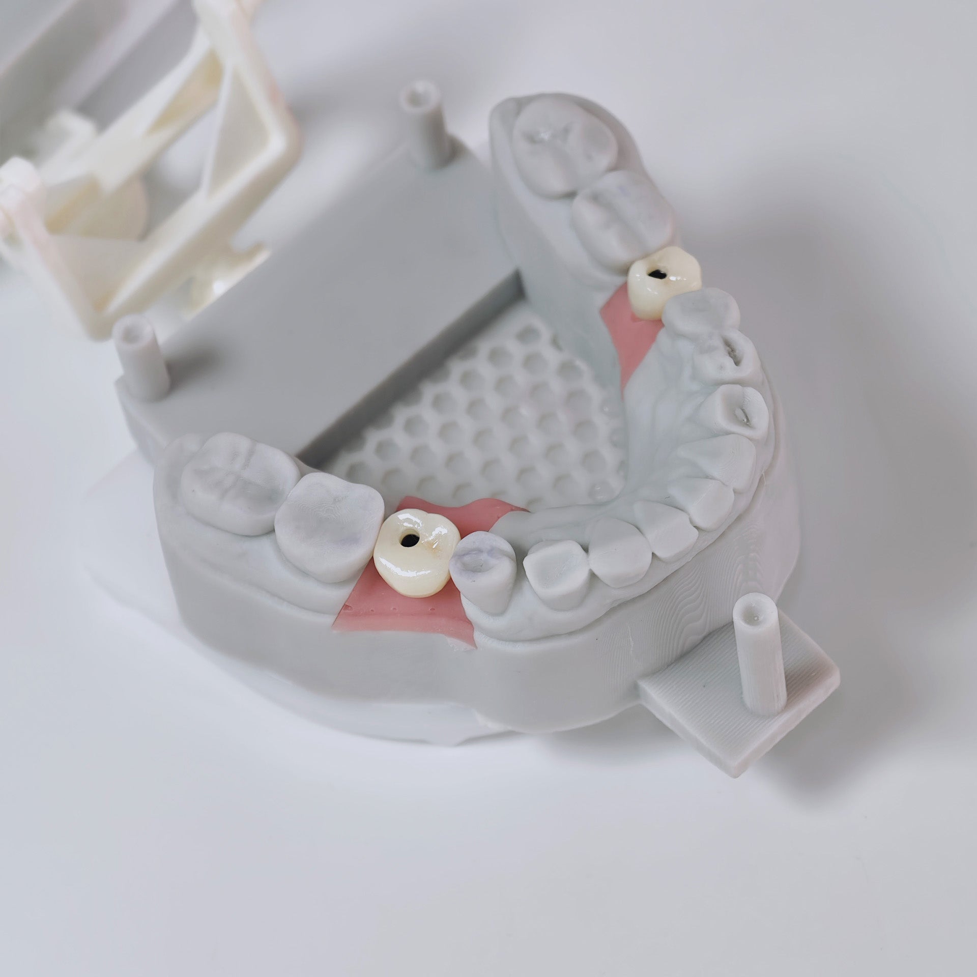 Zirconia Crown With Screw Retained